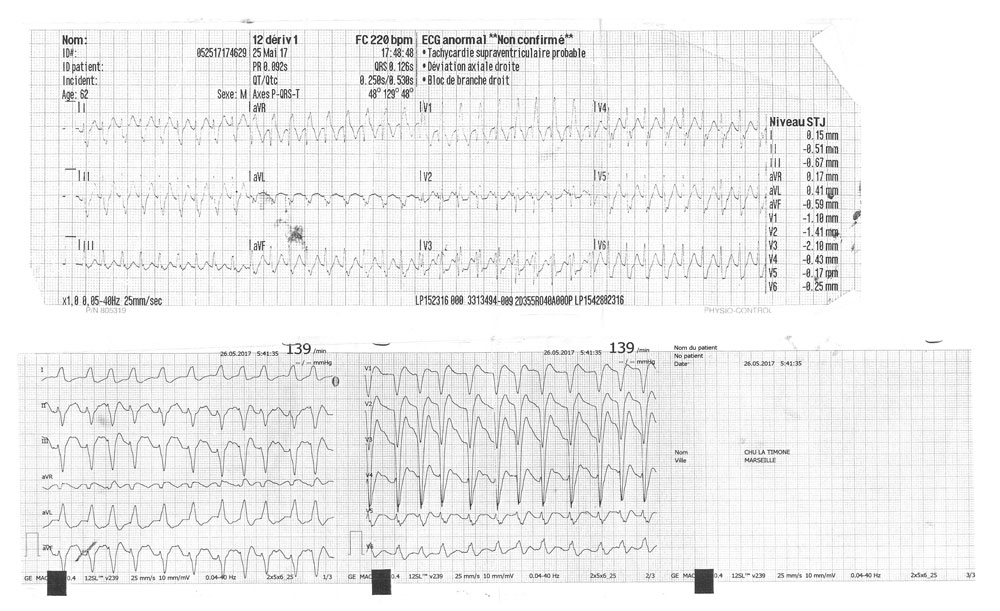 ECG